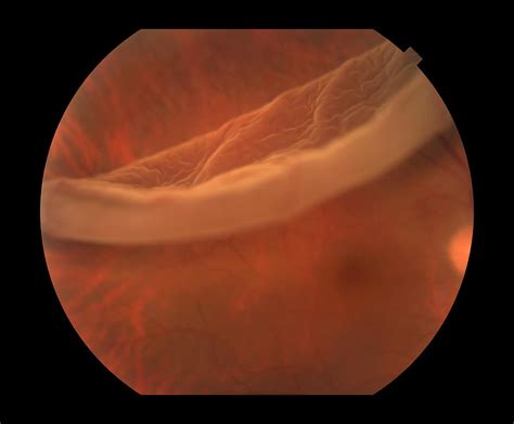 Most retinal detachments are a result of a retinal break, hole, or tear. Giant Retinal Tear Photograph by Paul Whitten