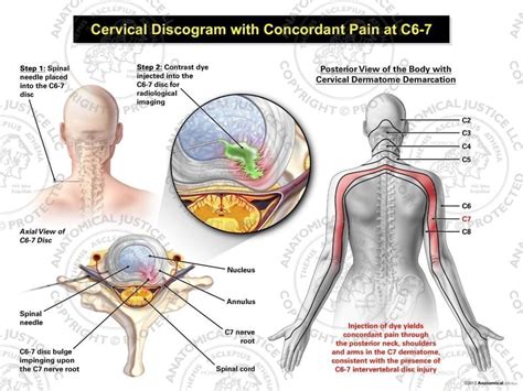 Female Left Cervical Discogram With Concordant Pain At C6 7