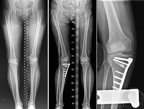 Valgus Overcorrection After Open Wedge High Tibial Osteotomy Hto With