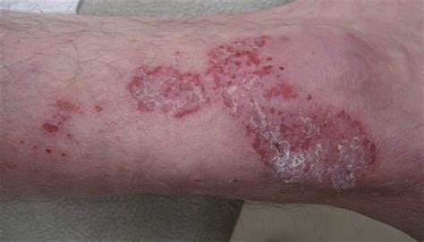 Itchy Burning Rash That Recurs On The Legs Every Winter