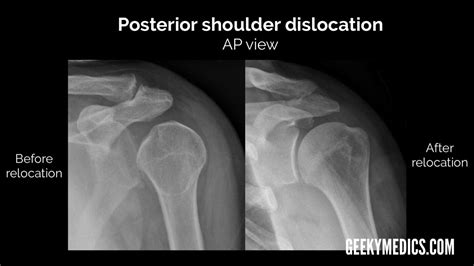 Shoulder X Ray Interpretation Radiology Geeky Medics