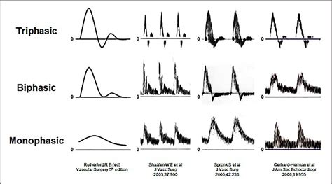 Figure 3 From Interpretation Of Peripheral Arterial And Venous Doppler