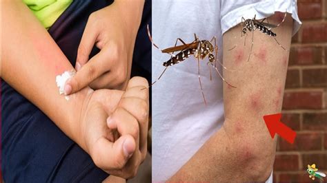 Picaduras De Mosquitos Aqu Remedios Caseros Para Tratar Y Disminuir El Dolor Picaz N Y Sus