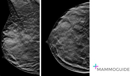Breast Imaging Cases Mammoguide Learn Breast Imaging