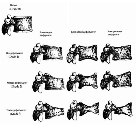 Semi-quantitative vertebral morphometry of Harry Genant ...