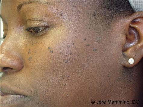 Eczema Face African American