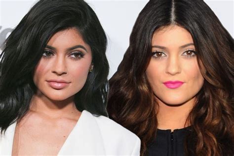 Kylie Jenners Cosmetic Surgeon Speaks About Her Amazing Metamorphosis