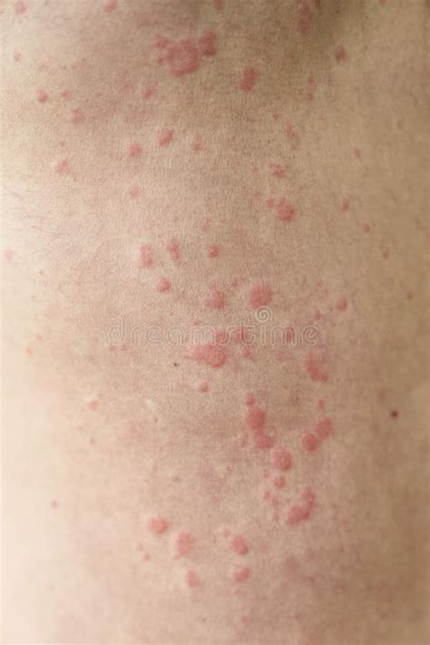 Skin Imperfection Skin Allergy Urticaria Disease Red Spots On The