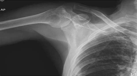 Fractured Coracoid Process With Acromioclavicular Joint Disl Medicine