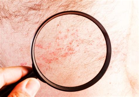 Alle infos zu gürtelrose bzw. Hautausschlag: Welche Krankheit steckt dahinter?
