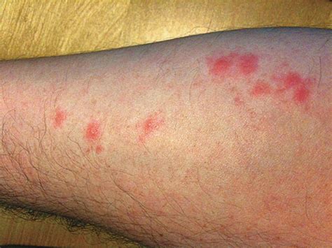 Bed Bug Bites Dermatology Conditions And Treatments
