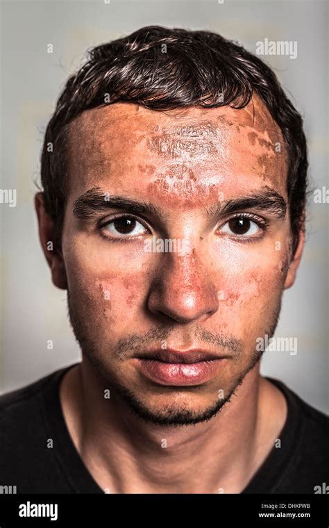 Sunburn Skin Peeling On Male Face Caused By Extended Exposure On Direct