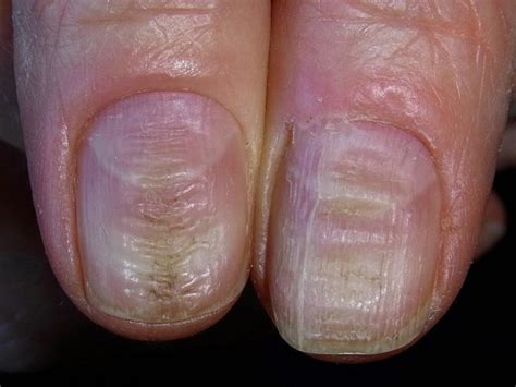 When they are deeper and more formed under the nail, they are called mees' lines. Lines on nails vitamin deficiency - Awesome Nail