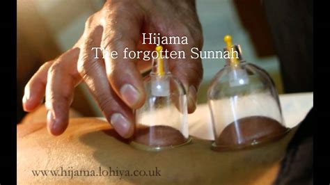 Hijama Cupping London E17 3 Minute Introduction YouTube