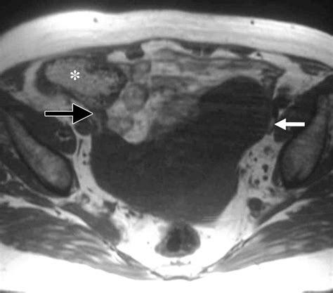 Giant Mucinous Cystadenoma Of The Appendix Radiographics