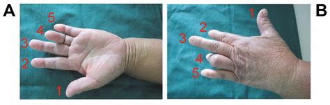 Successful Surgical Repair Of Central Slip Rupture In Finger Extensor