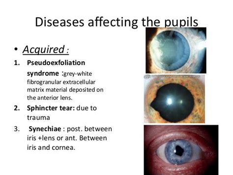 Abnormal Pupil Reactions