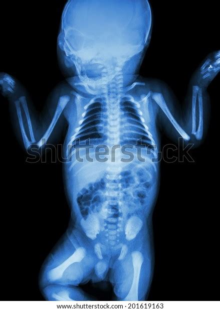 Check spelling or type a new query. Film Xray Whole Infants Body Stock Photo (Edit Now) 201619163