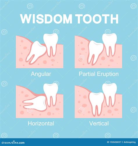 Abnormal Eruption Of Wisdom Tooth Dental Problems Cartoon Vector