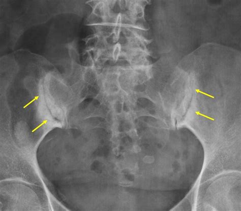 Sacroiliatis Radiology Cases