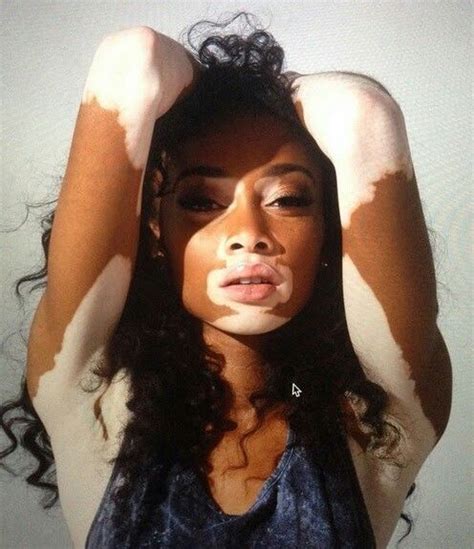 87 Best Beautiful Vitiligo Skin Images On Pinterest