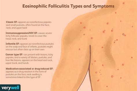 Eosinophilic Folliculitis Symptoms Treatment And More