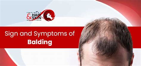 Hair Loss What Are The Top Most Common Signs Of Balding In Men And
