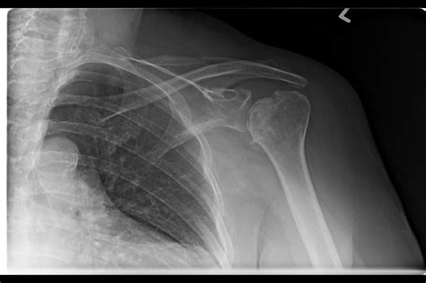 Ortho Dx Shoulder Pain After Recovery Of Humerus Fracture Clinical