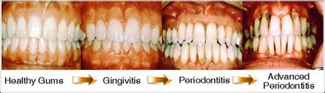 If the bacteria are cleaned out before it advances, it can be reversed. if gingivitis continues to advance, however, it could mean serious health consequences for your dog. How to Reverse Periodontal Disease Without Surgery