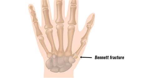 Bennetts Fracture Symptoms Causes Treatment And Rehabilitation