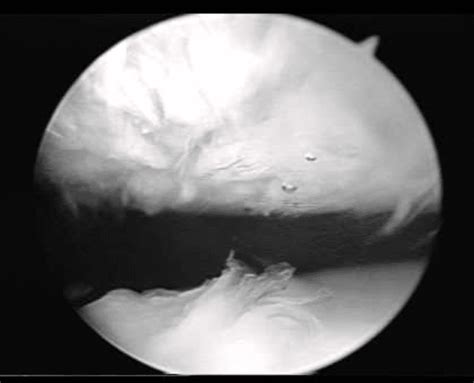 Knee Articular Hyaline Cartilage Injuries Chondromalacia Orthopedic