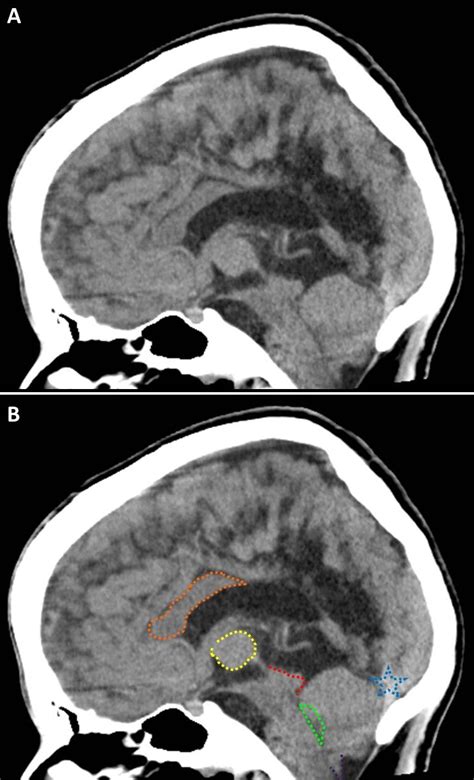 Arnold-Chiari malformation CT - wikidoc
