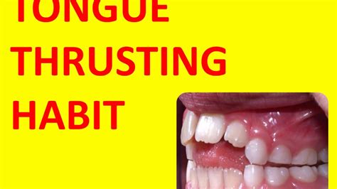 Tongue Thrusting Habit Youtube