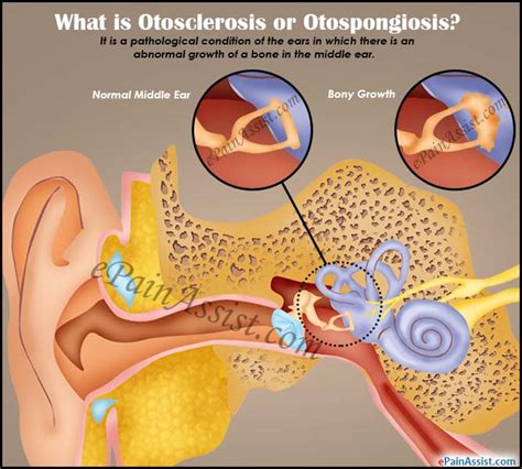 What Is Otosclerosis Or Otospongiosis Causes Symptoms Treatment