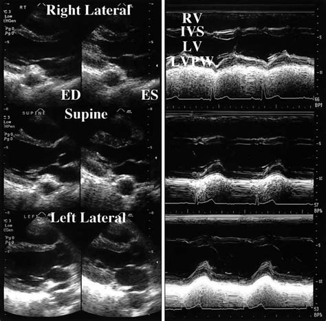 Transthoracic Echocardiogram Left Parasternal Long Axis 2dimensional