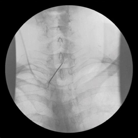 Cervical Nerve Root Blocks Anesthesia Key