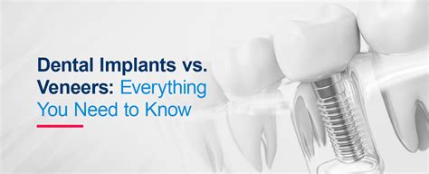 Dental Implants Vs Veneers Everything You Need To Know Hiossen