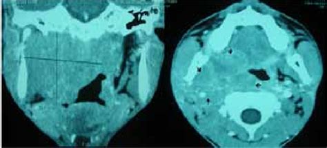 Ct Image Showing The Heterogeneous Enhancing Soft Tissue Mass In Right