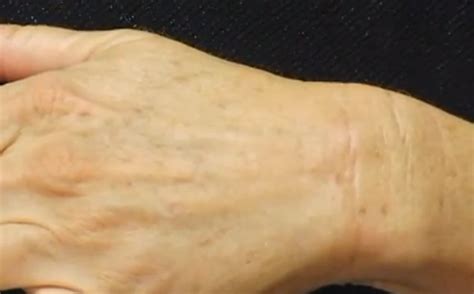 Check spelling or type a new query. Sunspots on Skin - Symptoms, Causes, Treatment, Images