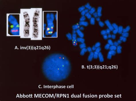 Abbott Molecular Laboratories Dual Fusion Mecom Rpn1 Abnormal Patterns
