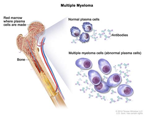 Bone Marrow Neoplasm Mybiosource Learning Center