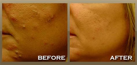 Skinnpeccable Photodynamic Therapy Los Angeles