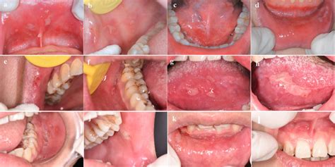 Recurrent Oral Erythema Multiforme A Case Series Report And Review Of