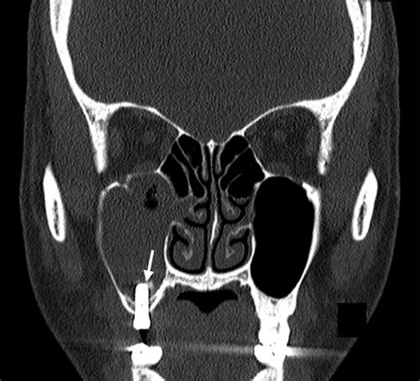 Paranasal Sinuses Computed Tomography Revealed Mucosal Thickening And