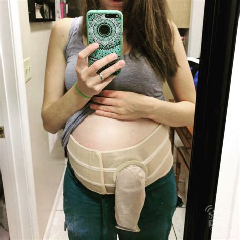 A cancer survivor has recreated famous celebrity photographs to show that living with a stoma bag is nothing to be embarrassed about: This Mother Has Been Battling With Her Health: Insides ...