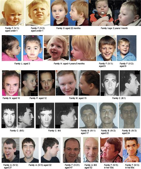 Facial Features Of Affected Individuals With Clcn4 Related Disorder In