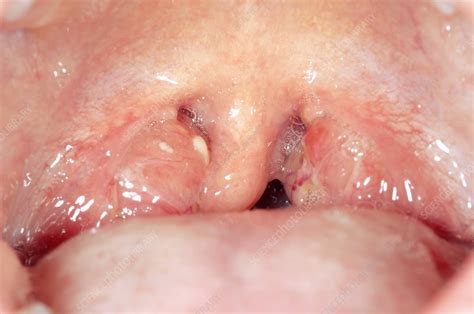 Tonsillitis Stock Image C0117354 Science Photo Library