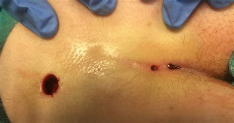 Sep 28, 2018 · a pilonidal sinus (pns) is a small hole or tunnel in the skin. Pilonidal cyst on the butt: Sinusectomy
