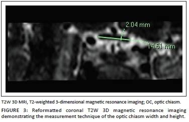 Normal Measurements Of The Optic Nerve Optic Nerve Sheath And Optic