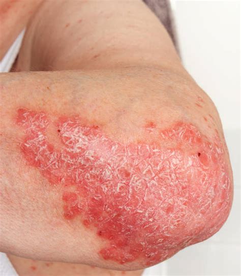 Psoriasis Elbows Stock Photos Pictures And Royalty Free Images Istock